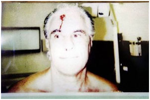 John Gotti after he was beaten up by an inmate