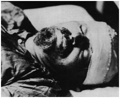 Leon Trotsky bandaged up shortly after he was attacked