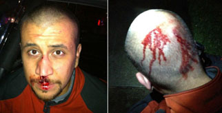 George Zimmerman injuries