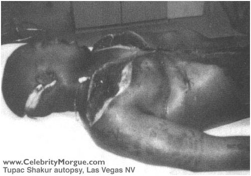 Tupac Shakur autopsy photo